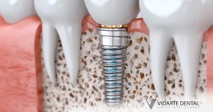 Bone Free Dental Implants