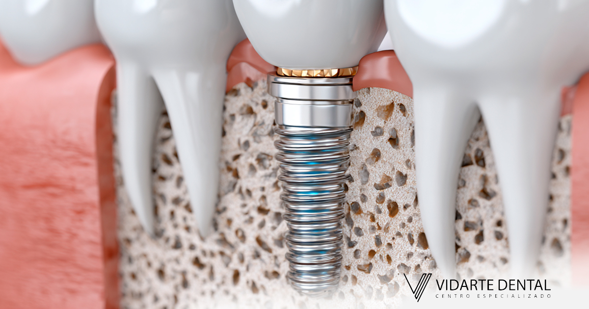 Bone Free Dental Implants