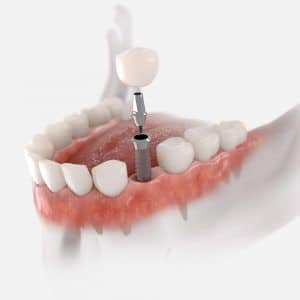 Implantes Dentales en Málaga