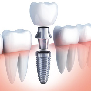 Implantes Dentales en Málaga