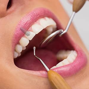 Implantes Dentales en Málaga