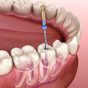 Endodoncia en Málaga - Endodoncias unirradiculares