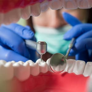 Endodoncia en Málaga - Endodoncias birradiculares