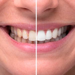 Blanqueamiento dental en Málaga con Philips Zoom