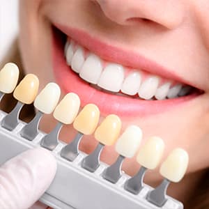 Blanqueamiento dental en Málaga con Philips Zoom