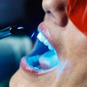 Tooth whitening