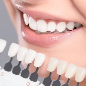 Dental veneers