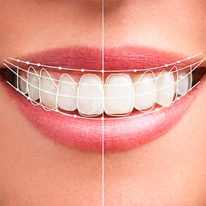 Aesthetic dental contouring