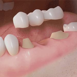 Dental crowns or caps