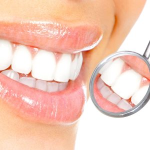lanqueamiento dental en Málaga con Philips Zoom