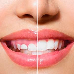 Gingivectomy
