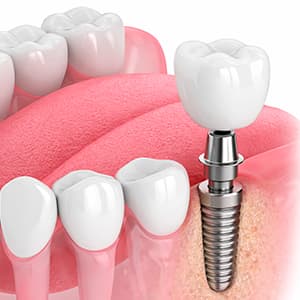 Implantes dentales