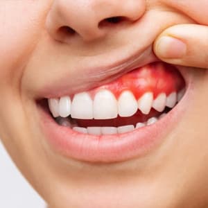 La Gingivitis