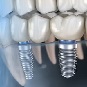 Dental implants